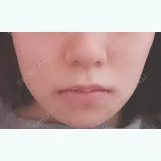 13日目の経過画像（1枚目）