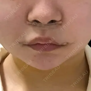 3日目の経過画像（1枚目）