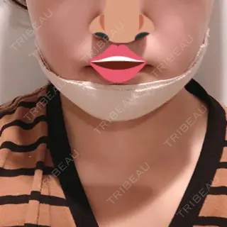 2日目の経過画像（1枚目）