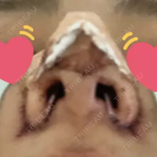 1日目の経過画像（2枚目）