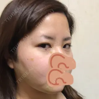 6日目の経過画像（2枚目）