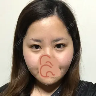 151日目の経過画像（1枚目）