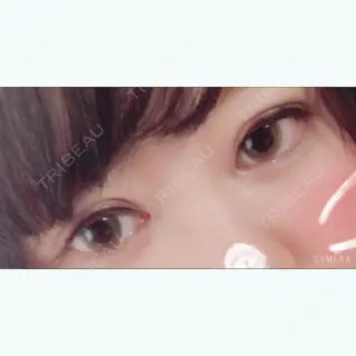 7日目の経過画像（2枚目）