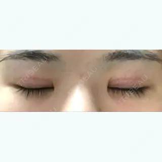 62日目の経過画像（2枚目）