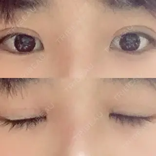 11日目の経過画像（1枚目）