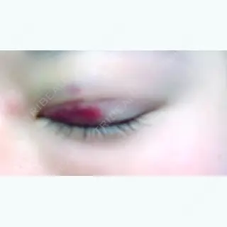 4日目の経過画像（2枚目）