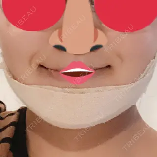 3日目の経過画像（2枚目）