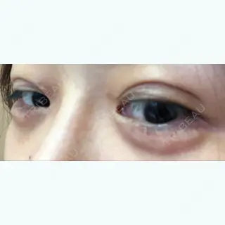 0日目の経過画像（2枚目）