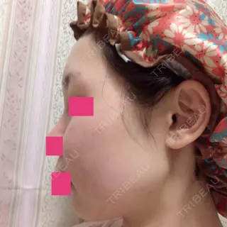 39日目の経過画像（3枚目）