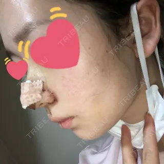 5日目の経過画像（2枚目）