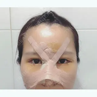 3日目の経過画像（1枚目）