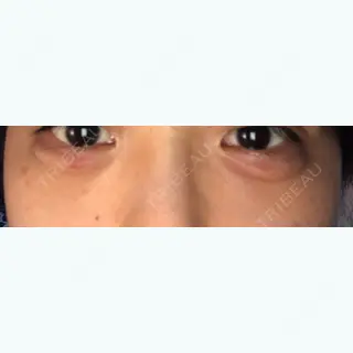 2日目の経過画像（1枚目）