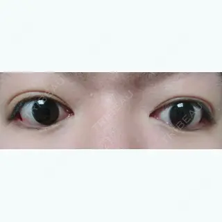 11日目の経過画像（2枚目）