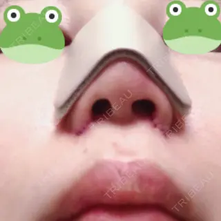 0日目の経過画像（3枚目）