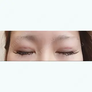 2日目の経過画像（3枚目）