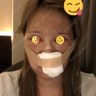 1日目の経過画像（1枚目）