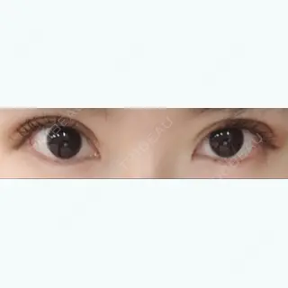 45日目の経過画像（1枚目）