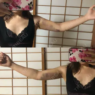 3日目の経過画像（2枚目）