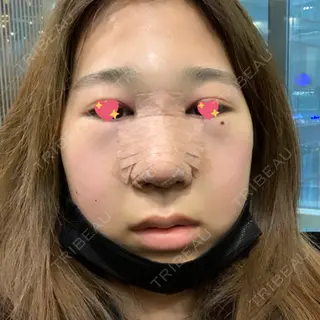 1日目の経過画像（1枚目）
