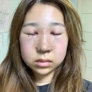 2日目の経過画像（1枚目）