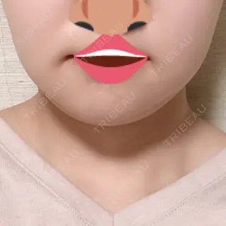 8日目の経過画像（1枚目）