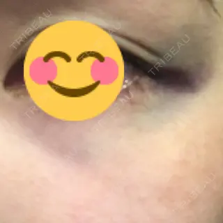 2日目の経過画像（3枚目）