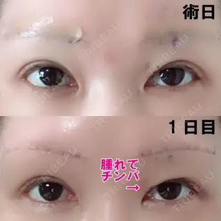 1日目の経過画像（1枚目）