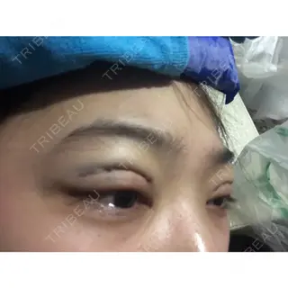 2日目の経過画像（3枚目）