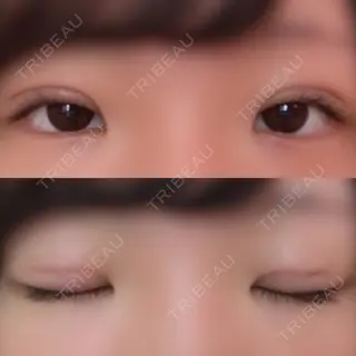 6日目の経過画像（1枚目）