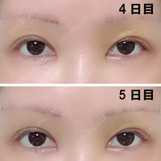 5日目の経過画像（1枚目）