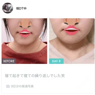 9日目の経過画像（3枚目）