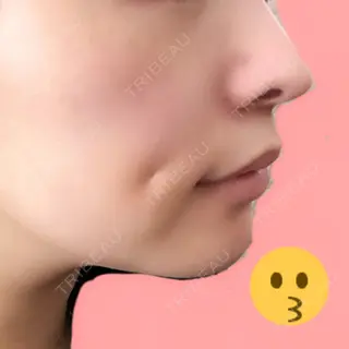 3日目の経過画像（2枚目）