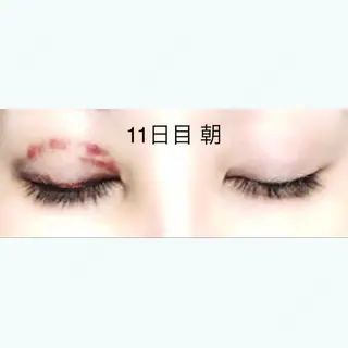 10日目の経過画像（3枚目）