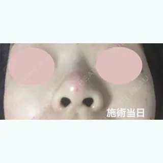 14日目の経過画像（1枚目）