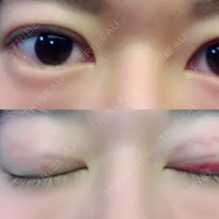 11日目の経過画像（1枚目）