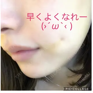 4日目の経過画像（2枚目）