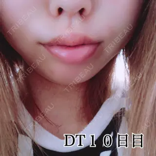 10日目の経過画像（2枚目）