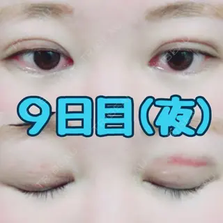 9日目の経過画像（2枚目）