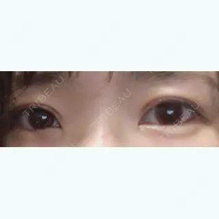 28日目の経過画像（1枚目）