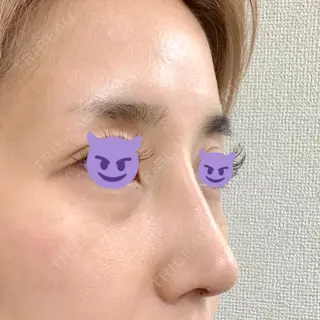 5日目の経過画像（2枚目）