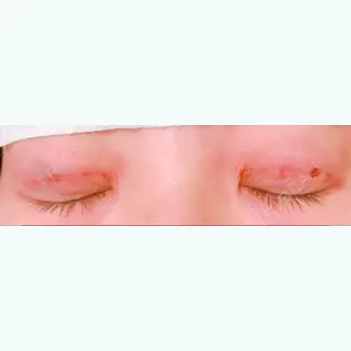 0日目の経過画像（2枚目）