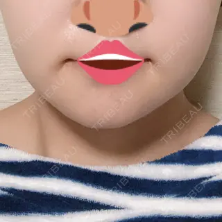 11日目の経過画像（1枚目）