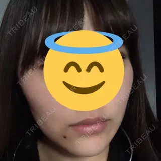 17日目の経過画像（2枚目）
