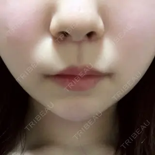 20日目の経過画像（1枚目）