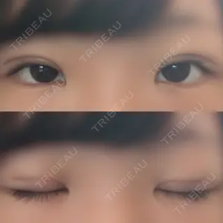 9日目の経過画像（1枚目）