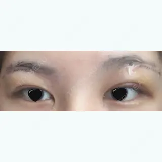 4日目の経過画像（1枚目）
