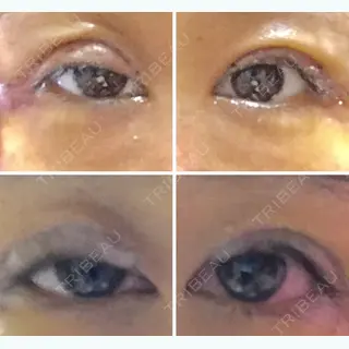 4日目の経過画像（1枚目）