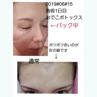 1日目の経過画像（1枚目）