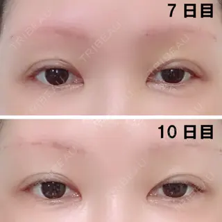 10日目の経過画像（2枚目）