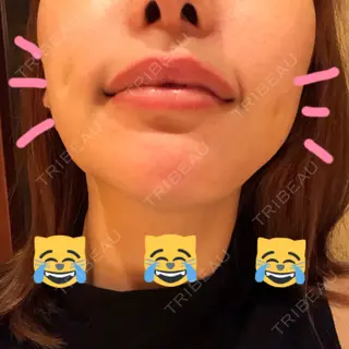 7日目の経過画像（3枚目）